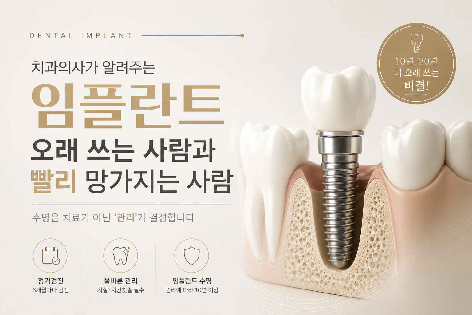 임플란트, 오래 쓰는 사람과 빨리 망가지는 사람의 차이는 무엇일까요?