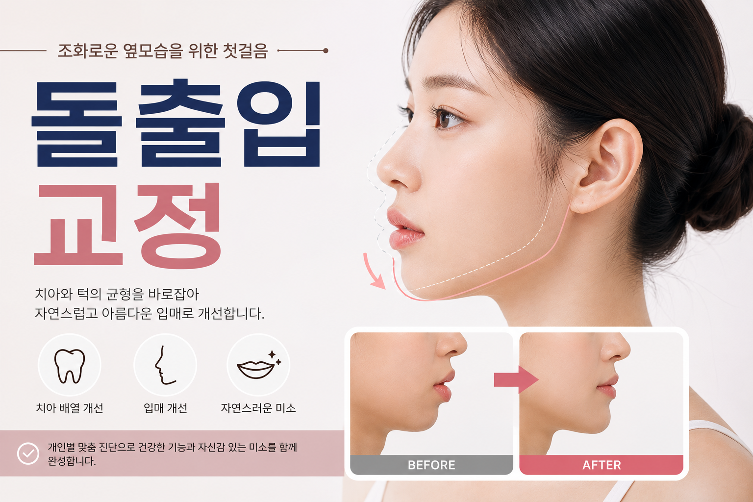 돌출입 교정에 관하여