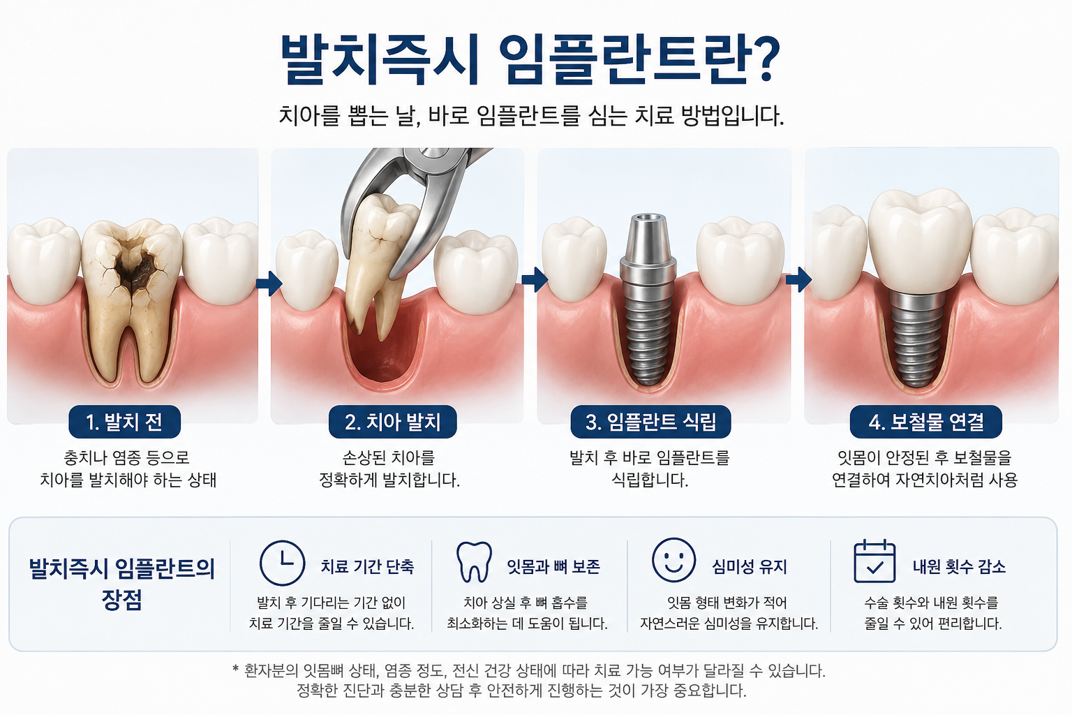 발치즉시 임플란트 과정