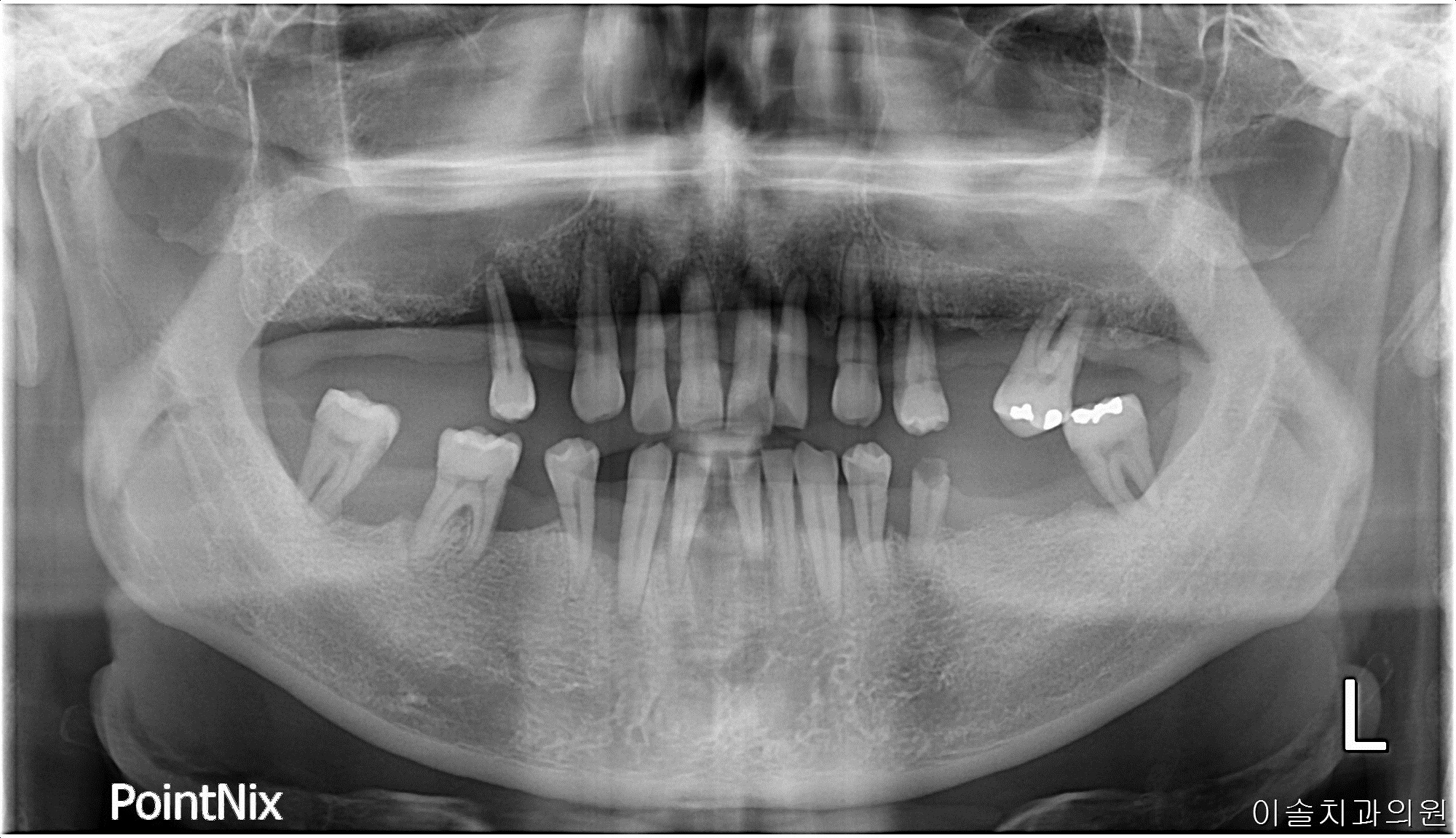 전악 발치 후 Full mouth rehabiitation 사례 치료 전