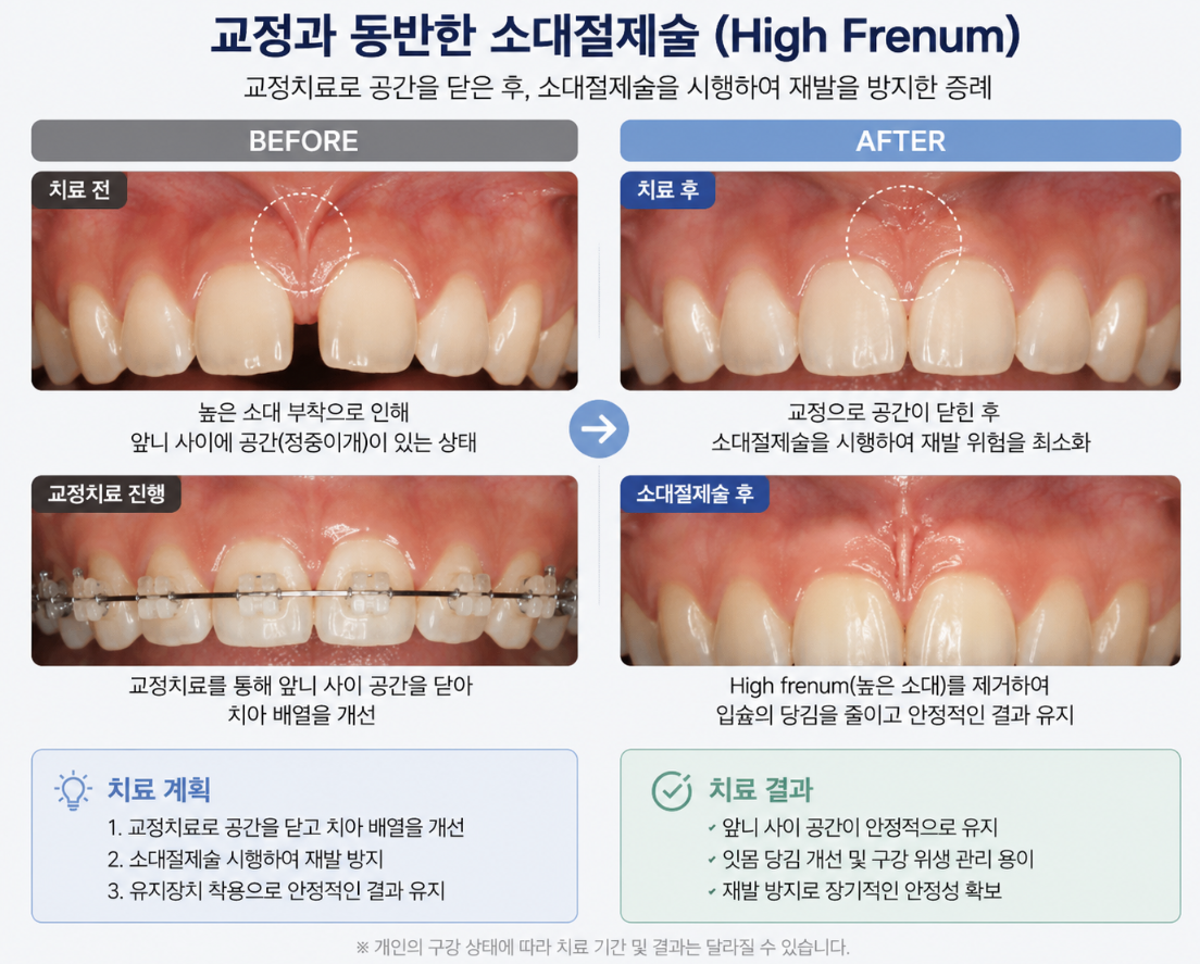 순소대절제술 치료사례