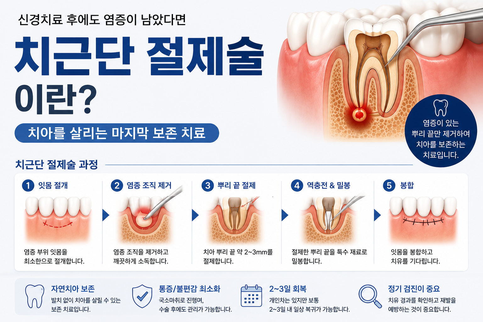 치근단 절제술, 신경치료 후에도 염증이 남았다면?