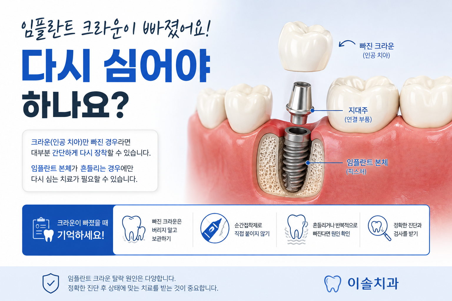 임플란트 크라운이 빠졌어요, 다시 심어야 하나요?