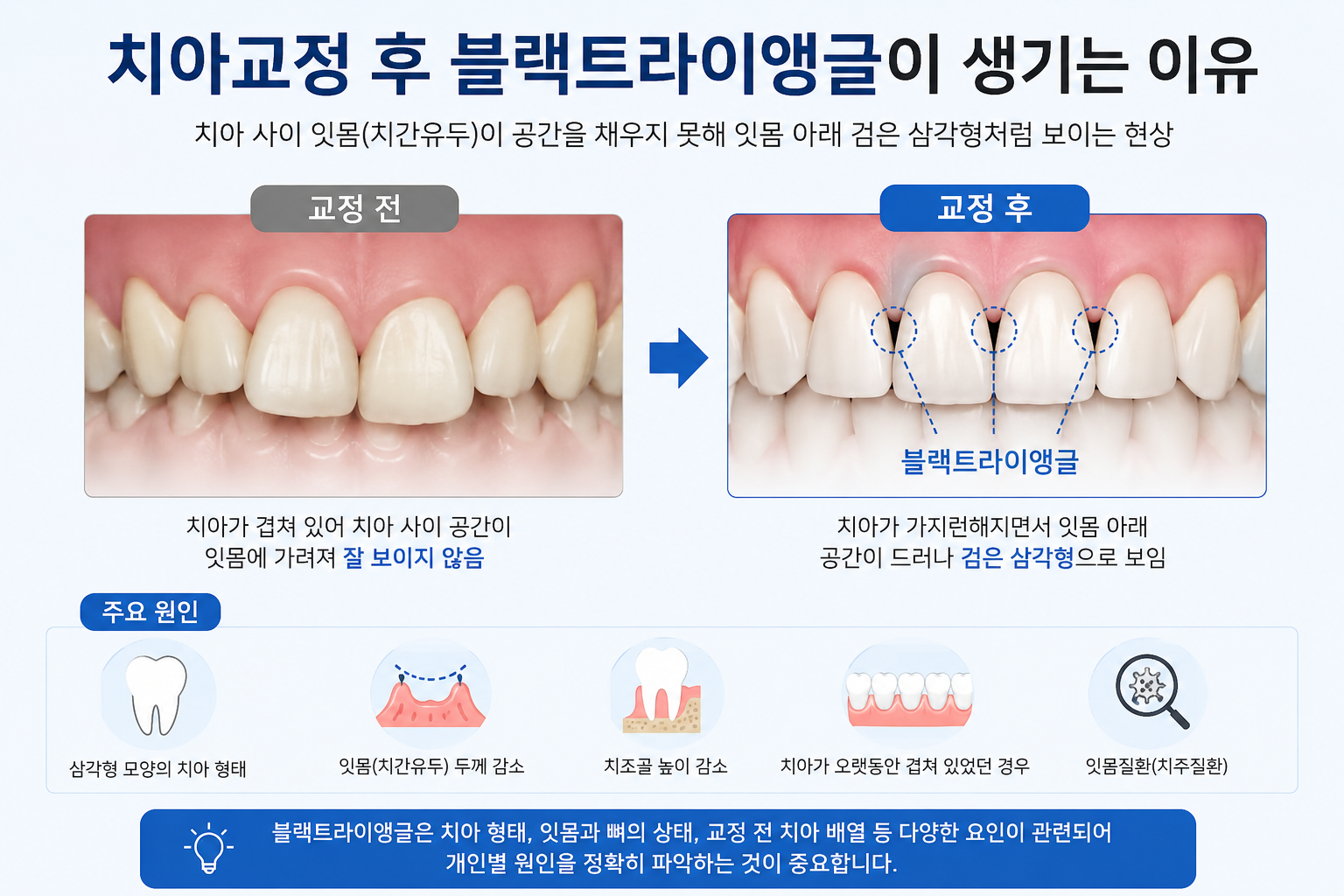 치아교정하면 블랙트라이앵글이 생기나요? 치아 사이 검은 공간이 보이는 이