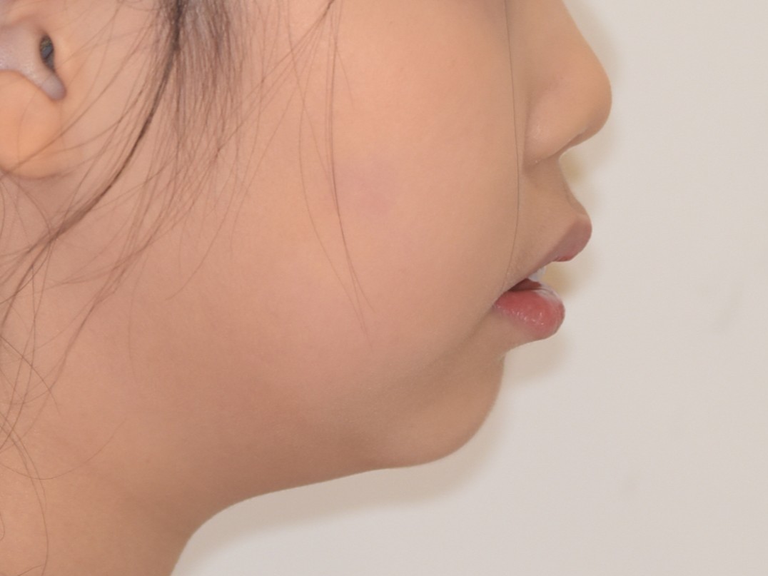 성장기 무턱 교정 치료사례 치료 전