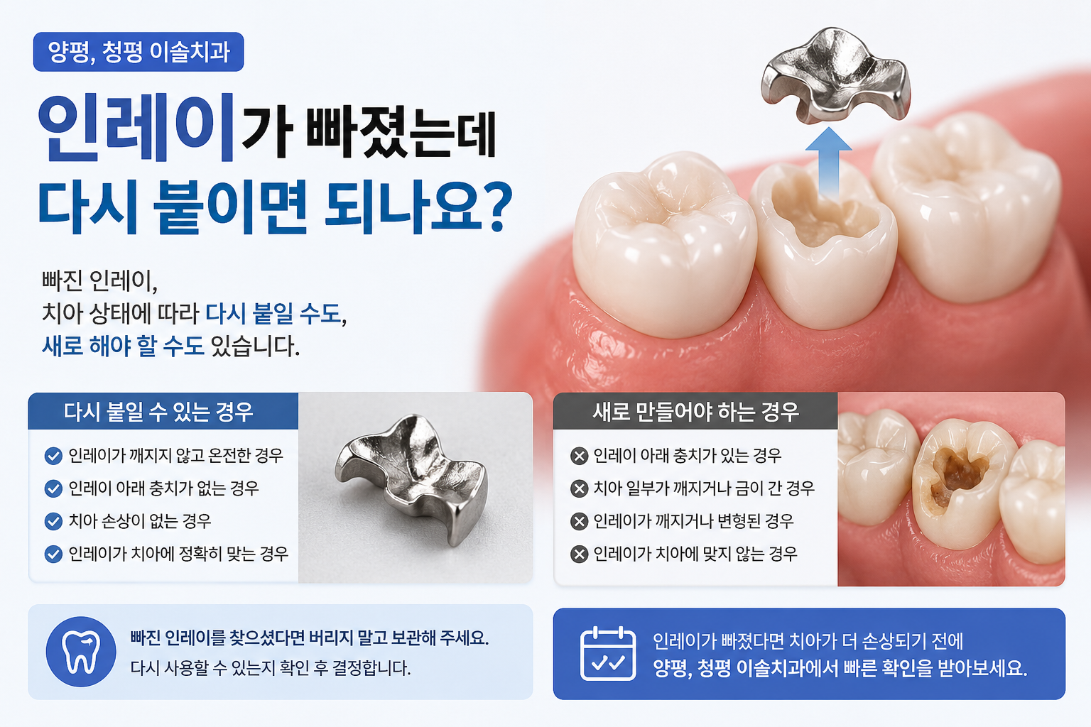 인레이가 빠졌는데 다시 붙이면 되나요? 재사용 가능한 경우와 다시 치료해야 하는 경우